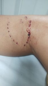 Menino de 8 anos é atacado por cobra em represa de Uberlândia; mordida impressiona | Triângulo Mineiro
